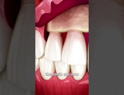 The Surgery To Reveal More Teeth 😨