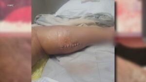 Mom says she was given days to live after spider-bite nightmare